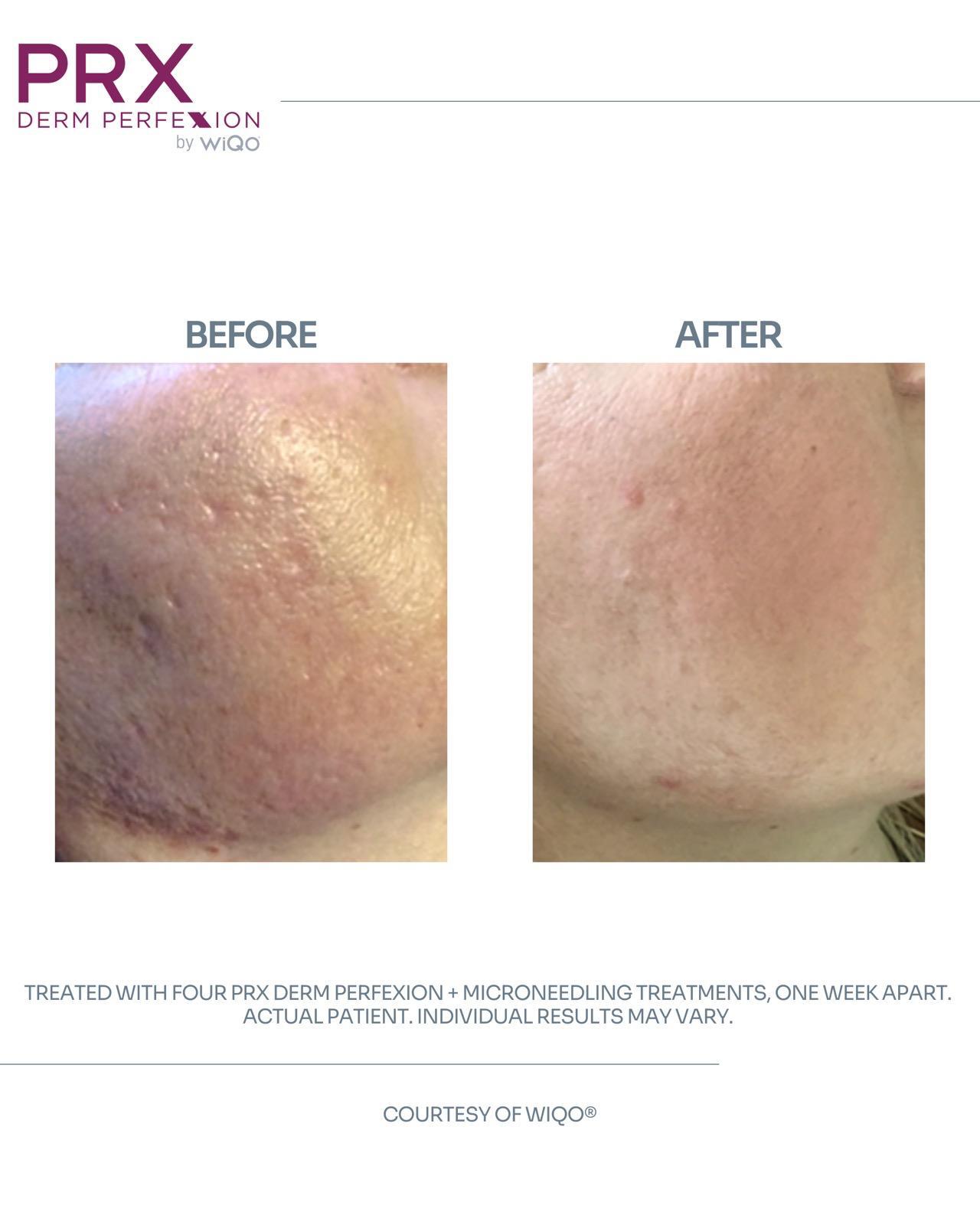 PRX Treatment