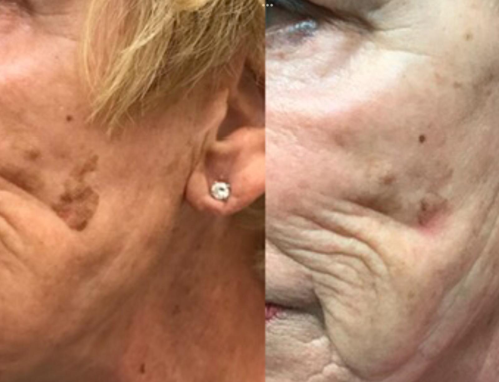Plasma Pen Skin Tags Vein Removal